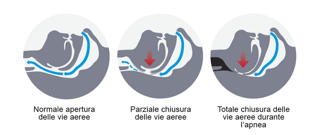 apnea notturna